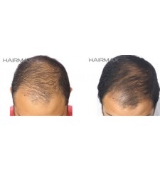 HairMax - profesionalni laserski glavnik 12